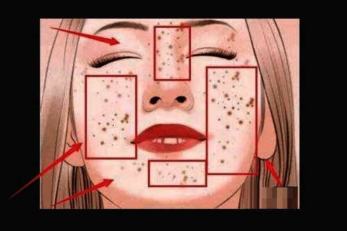 人物脸部特写照片，清晰展示多处斑点和瑕疵